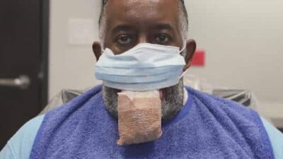 Anthony Jones of Houston suffered from an enlarged tongue as a side effect of COVID-19