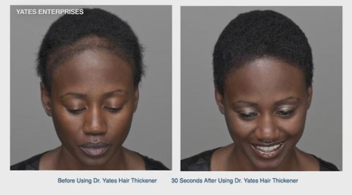 EURVideoNews: Treating Black Female Hair Loss | WATCH | EURweb
