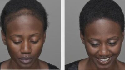 Black Female balding and with full head of hair