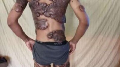 Davontae Stewart (keloids scarring)