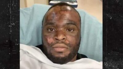 Neyo White (burns) - screenshot - Chemical Peel Victim