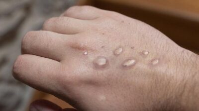 monkeypox - Getty