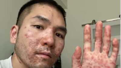 Man with Monkeypox - screenshot