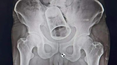 Man with Tumbler inserted in rectum