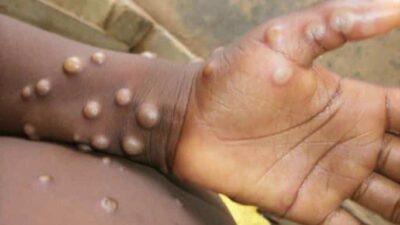 Monkeypox - World Health Organization