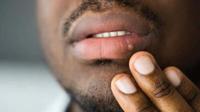 STD (herpes victim) - Getty