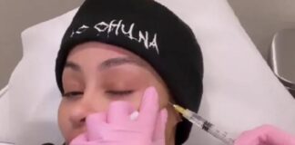 Blac Chyna getting face-fillers removed - Instagram