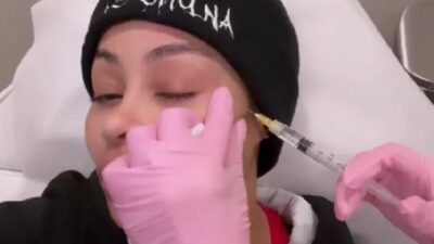 Blac Chyna getting face-fillers removed - Instagram