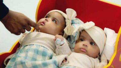 Formerly conjoined twins - via Cooks Childrens Hospital