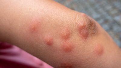 Bedbug bites on female hand skin