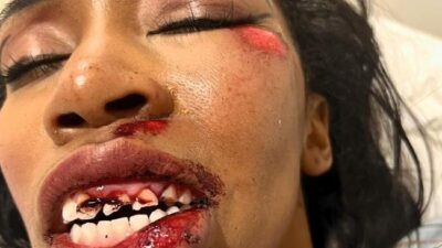 Carrie Bernans (injury) - Instagram