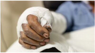Patient with burns