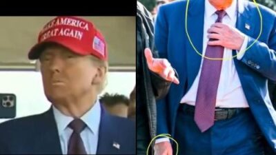 Donald Trump with bruises on hands - via X