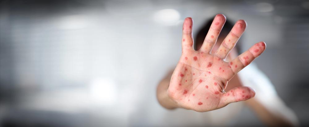 Measles - Depositphotos