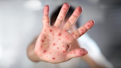 Measles - Depositphotos