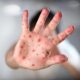 Measles - Depositphotos