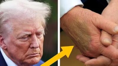 Trump and Bruised Hand - screenshot