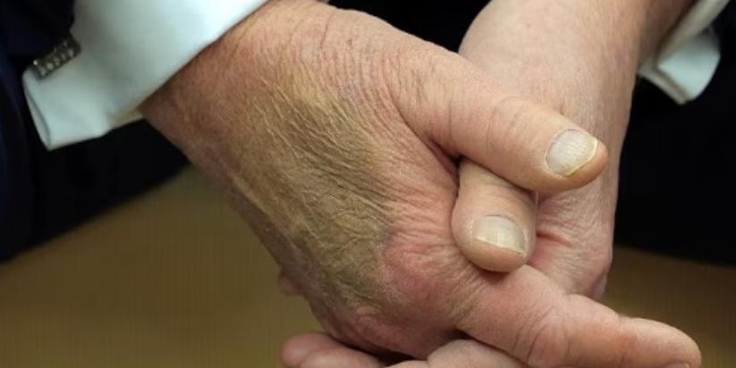 Trump's bruised hand - screenshot