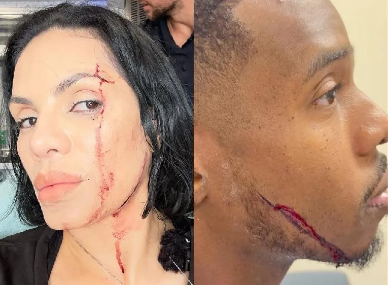 Nina Santiago - Patrick Blackwood and their injuries from car crashing into restaurant they were food-reviewing (via Instagram)