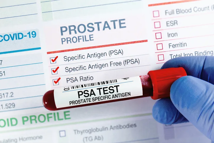 Blood sample for analysis of PSA Prostate Specific Antigen profile test 