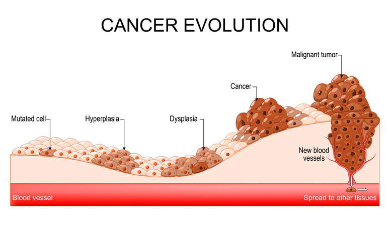 Cancer evolution. Mutated cell, Hyperplasia, Dysplasia, Malignant tumor. stock illustration