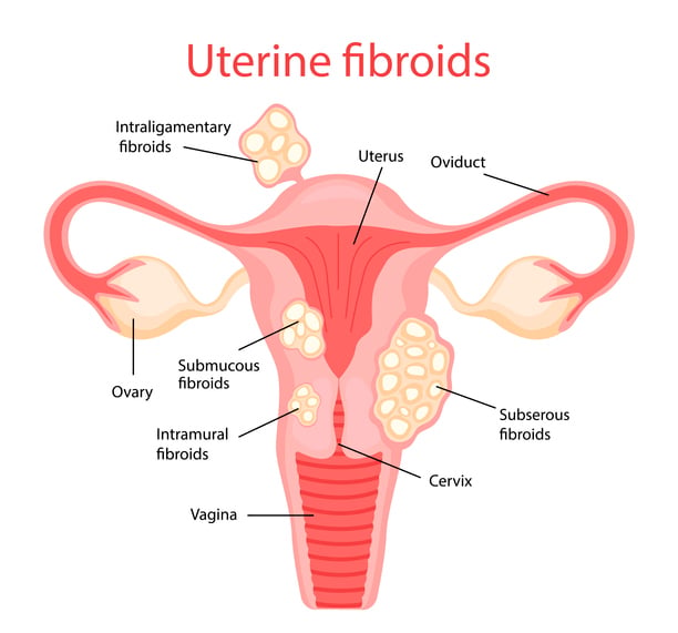 Uterine Fibroid chart stock photo