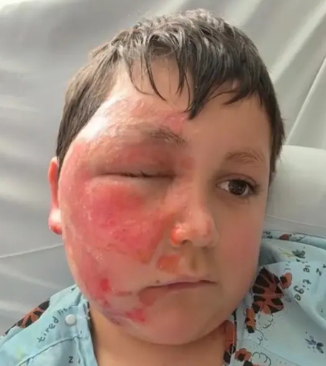 TikTok trend leaves 9-year-old boy with severe burns from microwaved ‘NeeDoh’ toy