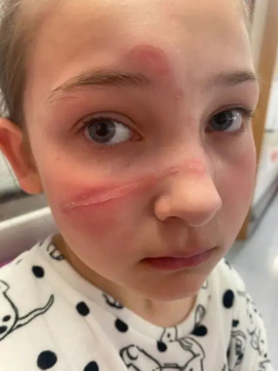 Bella suffered facial burns after a TikTok-inspired challenge caused molten toy material to splatter across her face.