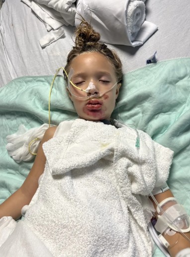 child uffered facial burns after a TikTok-inspired challenge caused molten toy material to splatter across her face.