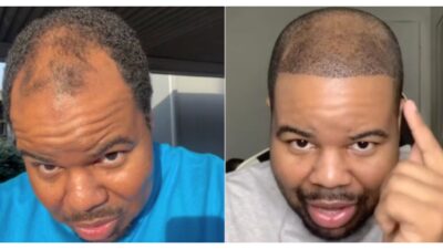 &lsquo;90 Day Fianc&eacute;&rsquo; Star Shows Off Major Transformation After Weight Loss and Hair Transplant