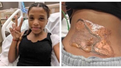 Bakersfield freshman Bridgette Chocoteco suffered second- and third-degree burns after being restrained on a sun-heated metal utility plate.