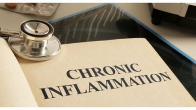 Chronic Inflammation is shown using the text as medical concept stock photo