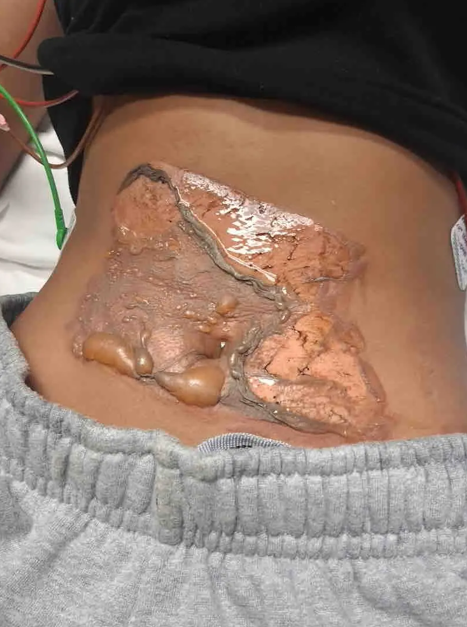 Bakersfield freshman Bridgette Chocoteco suffered second- and third-degree burns after being restrained on a sun-heated metal utility plate.