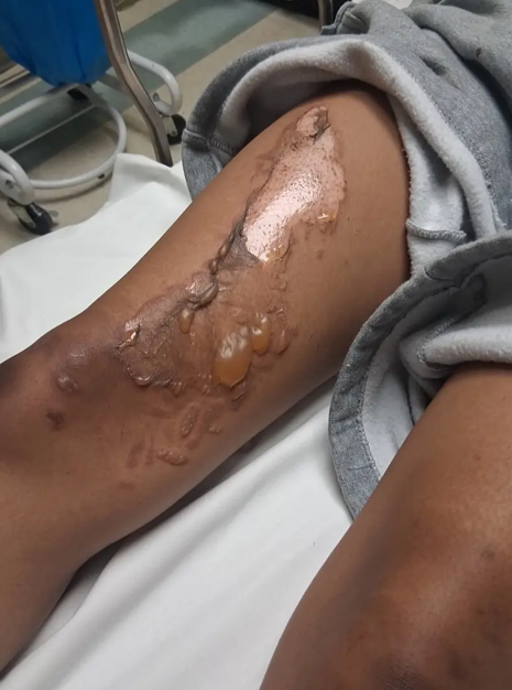 Bakersfield freshman Bridgette Chocoteco suffered second- and third-degree burns after being restrained on a sun-heated metal utility plate.